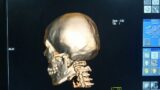 CT Scan Face of Human || Facial bones || Skull Bone || #CT SCAN #3D