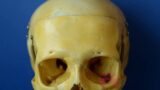 Bone – Skull – Frontal and Parietal Bones
