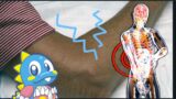 Bubble Has 'Video Game Elbow'  Lateral Epicondylitis